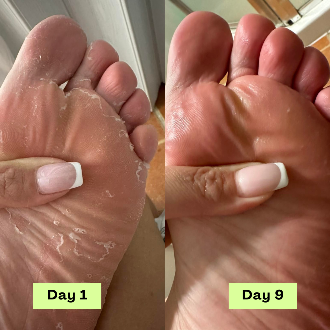 FungiFree® AntiFungal Relief Soap Bar